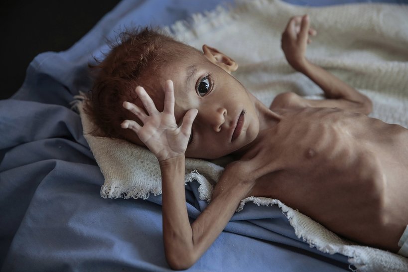 głodująca siedmiolatka na okładce New York Times, klęska głodu w Jemenie